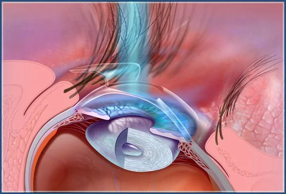 Eyelasik72.jpg
