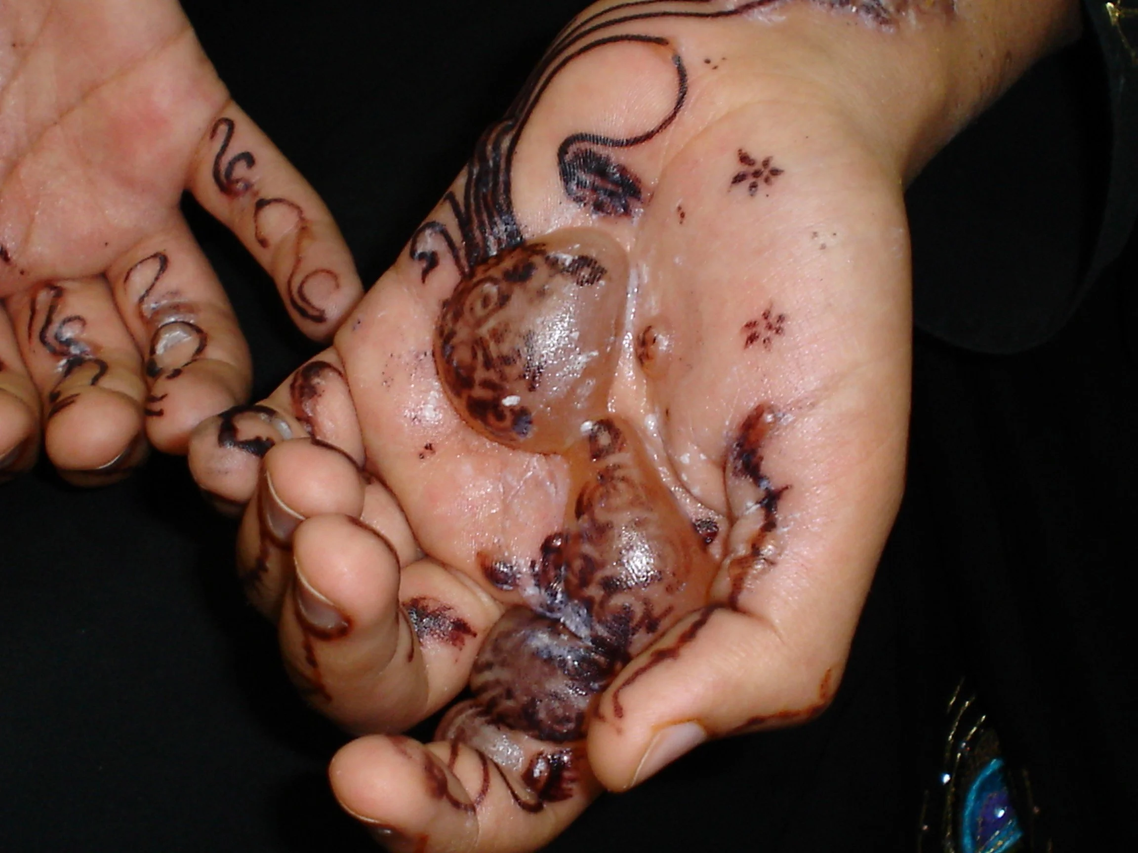 black henna allergy.jpg