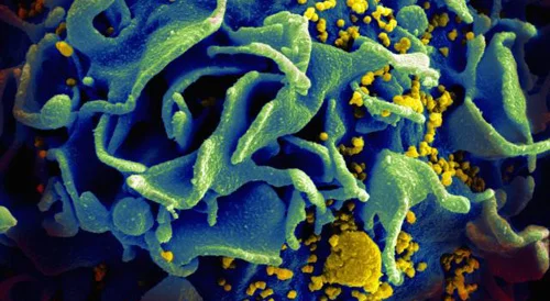An HIV-infected T cell (Source: NIAID)