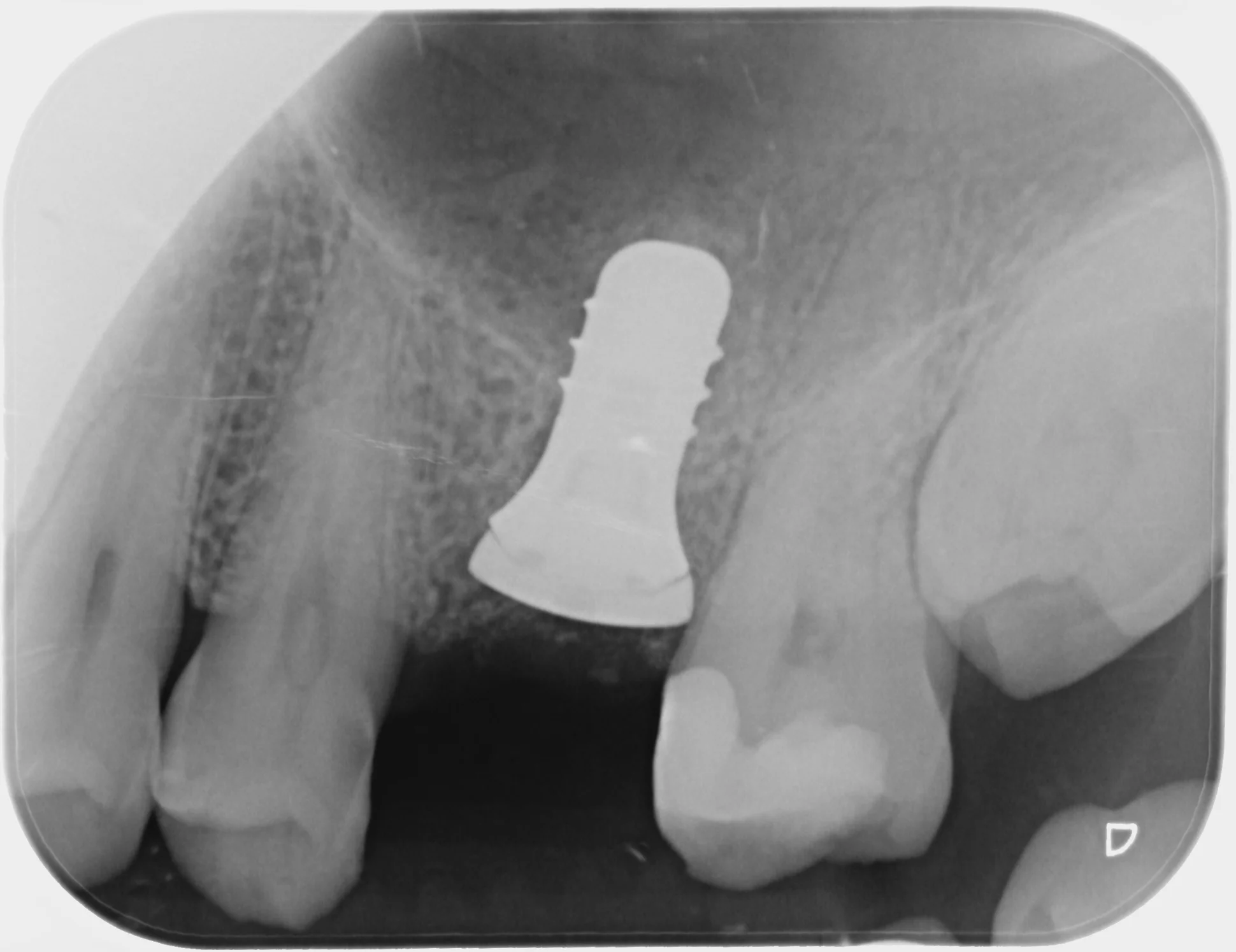 If we’re really going down the TMI rabbit hole, what you’re seeing on this x-ray is an 8mm long, 4.8mm diameter Wide Neck Standard Plus Straumann SLActive® Roxolid® implant . The Roxolid® bit means it’s made out of a titanium zirconium alloy. The SLActive ® bit means the surface of the implant is “high performance” with “extensive healing potential” — meaning it has nano structures on its surface so that, when the bone around it grows, it has more of the implant surface to grow into and grip onto.
