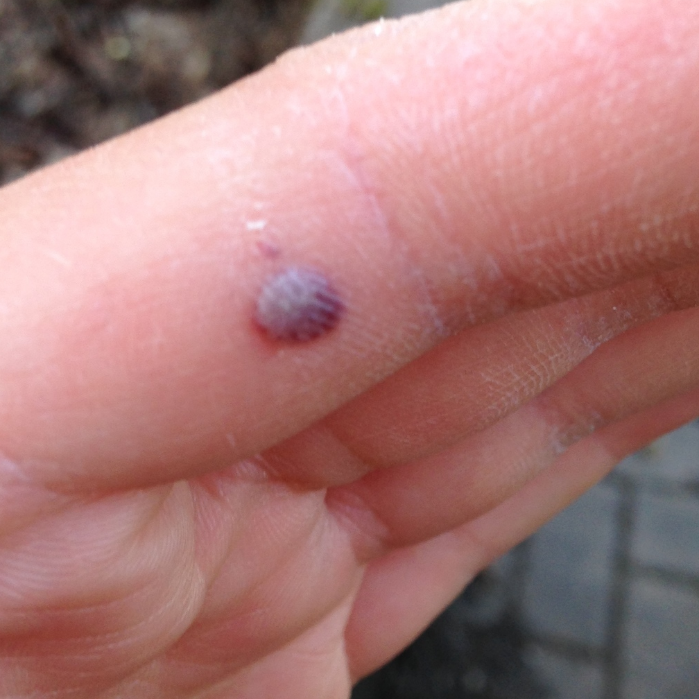 Blood Blister. Even the not-pokey end of the shears are dangerous. Worst.