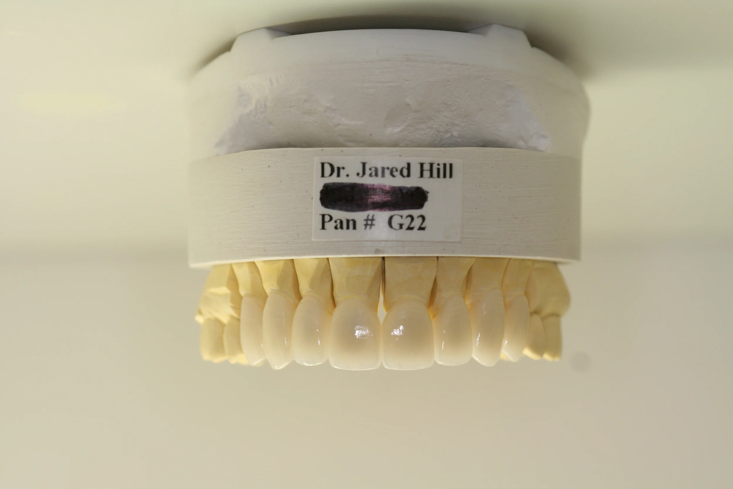 We worked with Treasure Dental Lab in Idaho Falls on this case in order to achieve the optimal results.