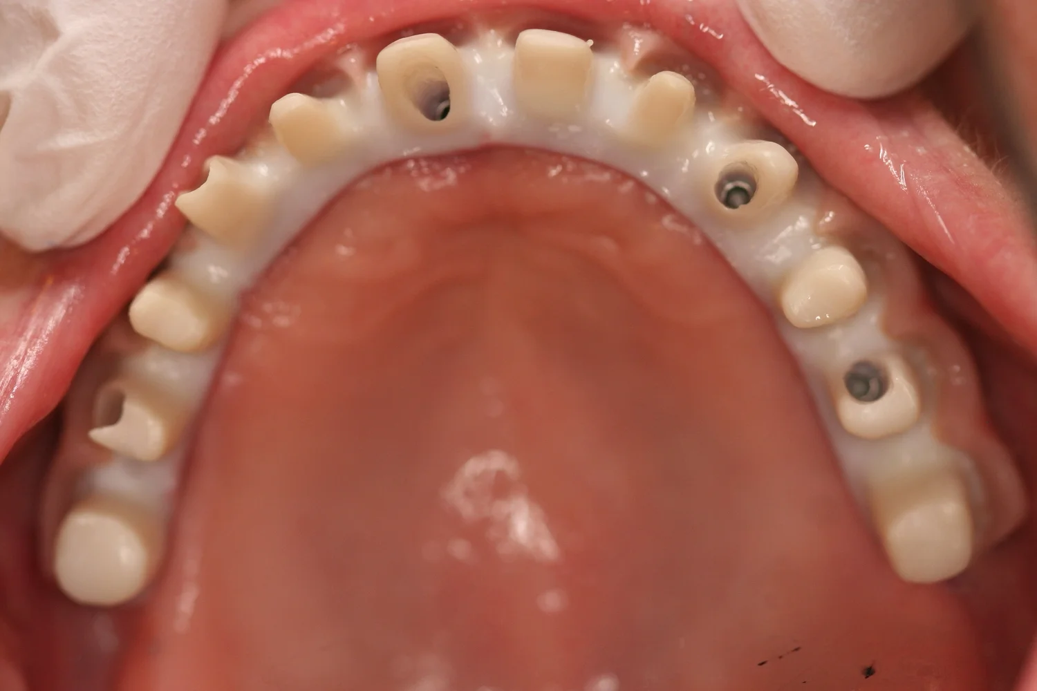 Note that the zirconia substructure is screwed directly into the dental implants.