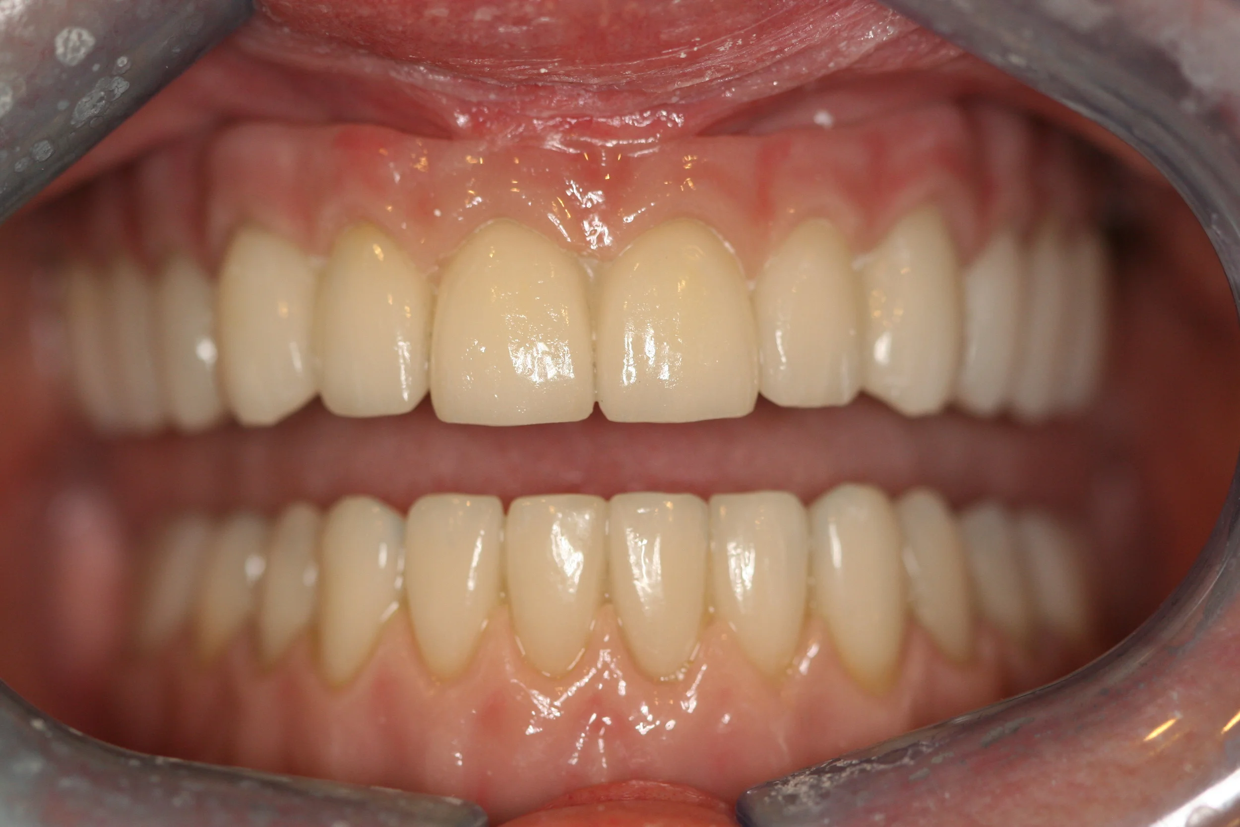 The final result from a very happy patient.