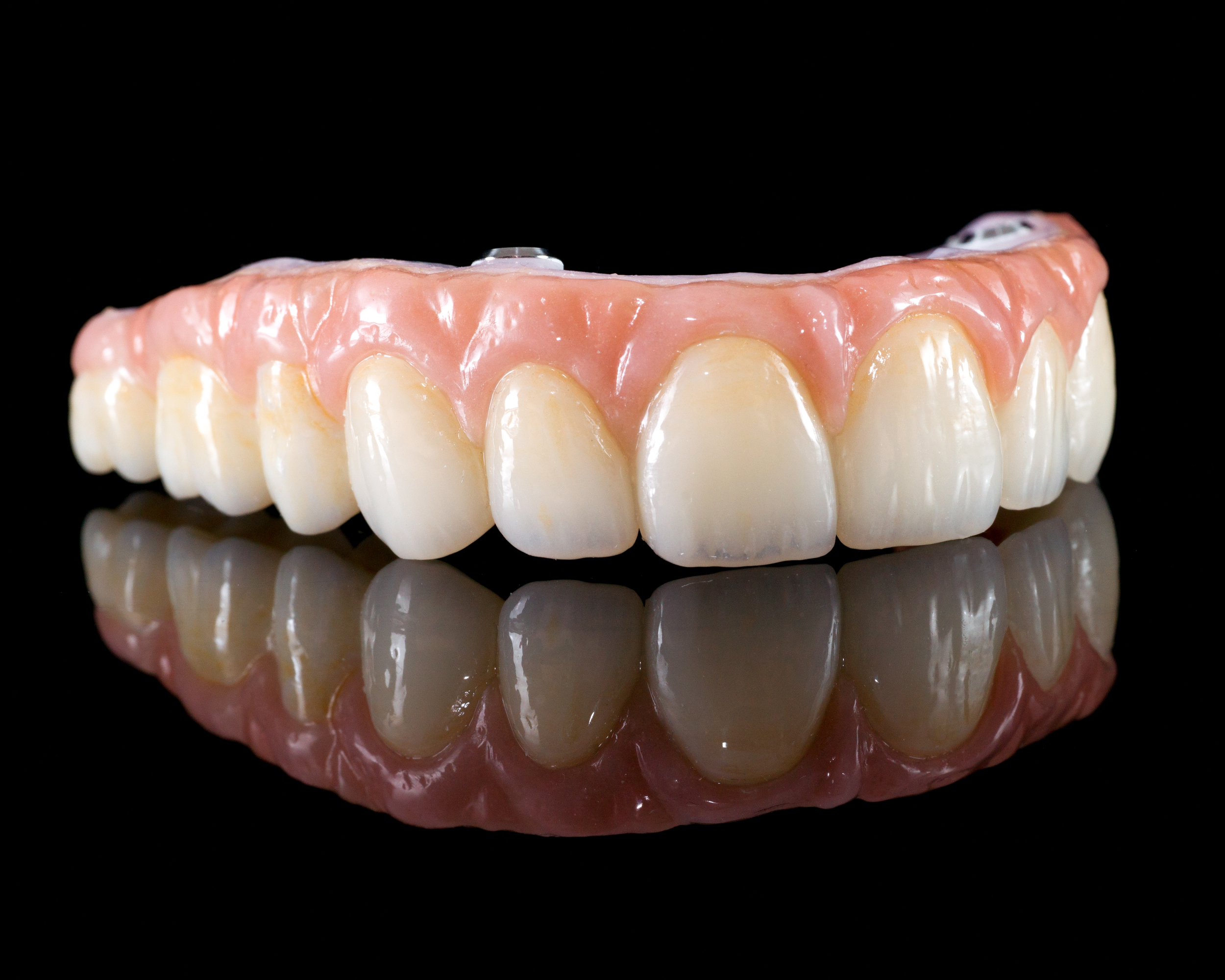 This type of restoration is called the Zurich Bridge. It consists of a zirconia substructure with overlaying porcelain teeth.