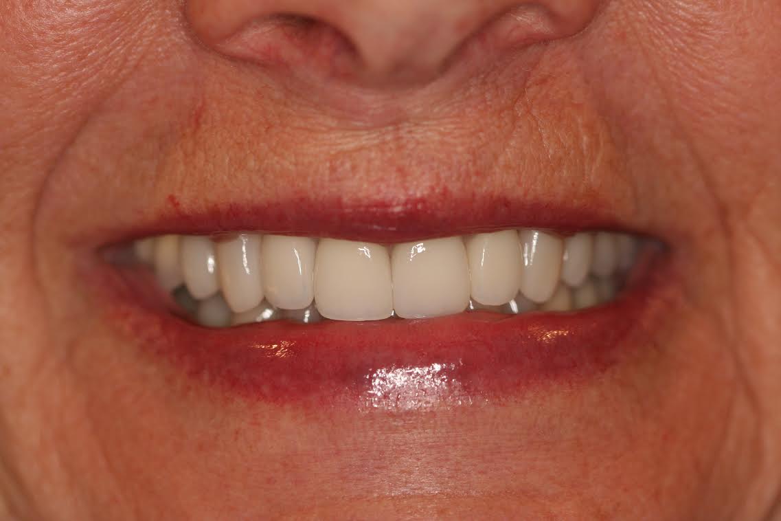 Dr. Hill's patient, J.F. after restoration with all porcelain veneers