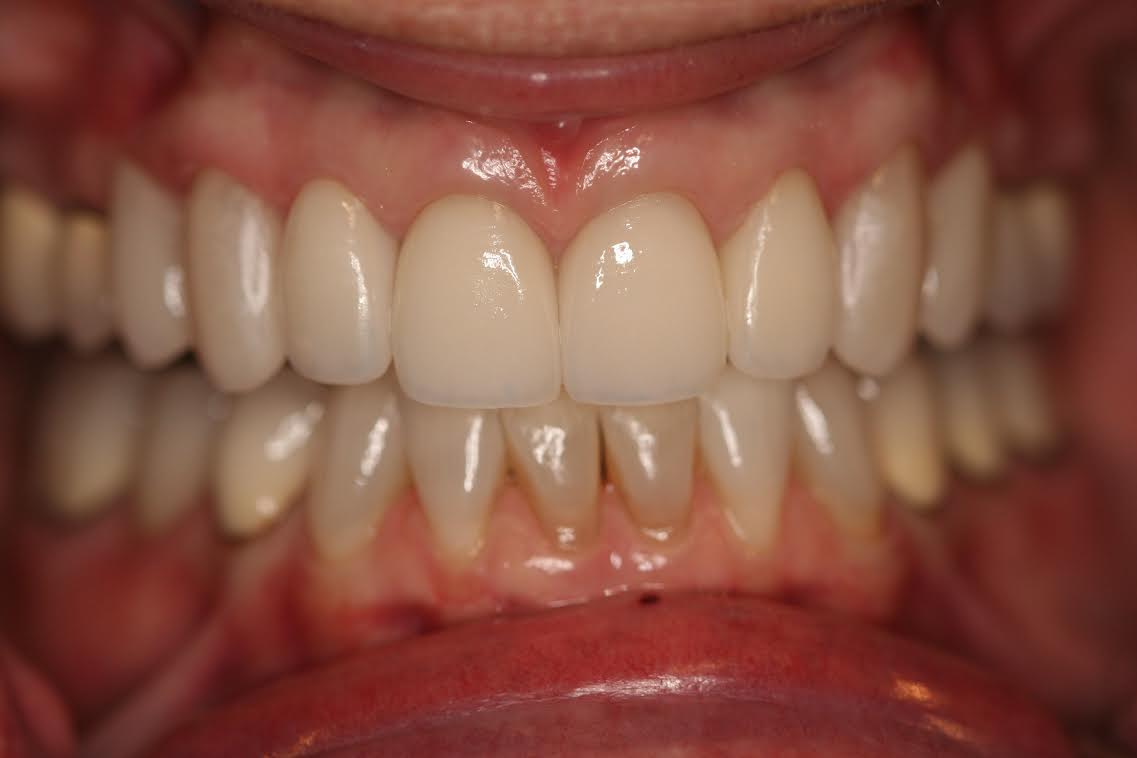 Note that the new veneers cover the entire tooth and give the patient a more "youthful" smile.