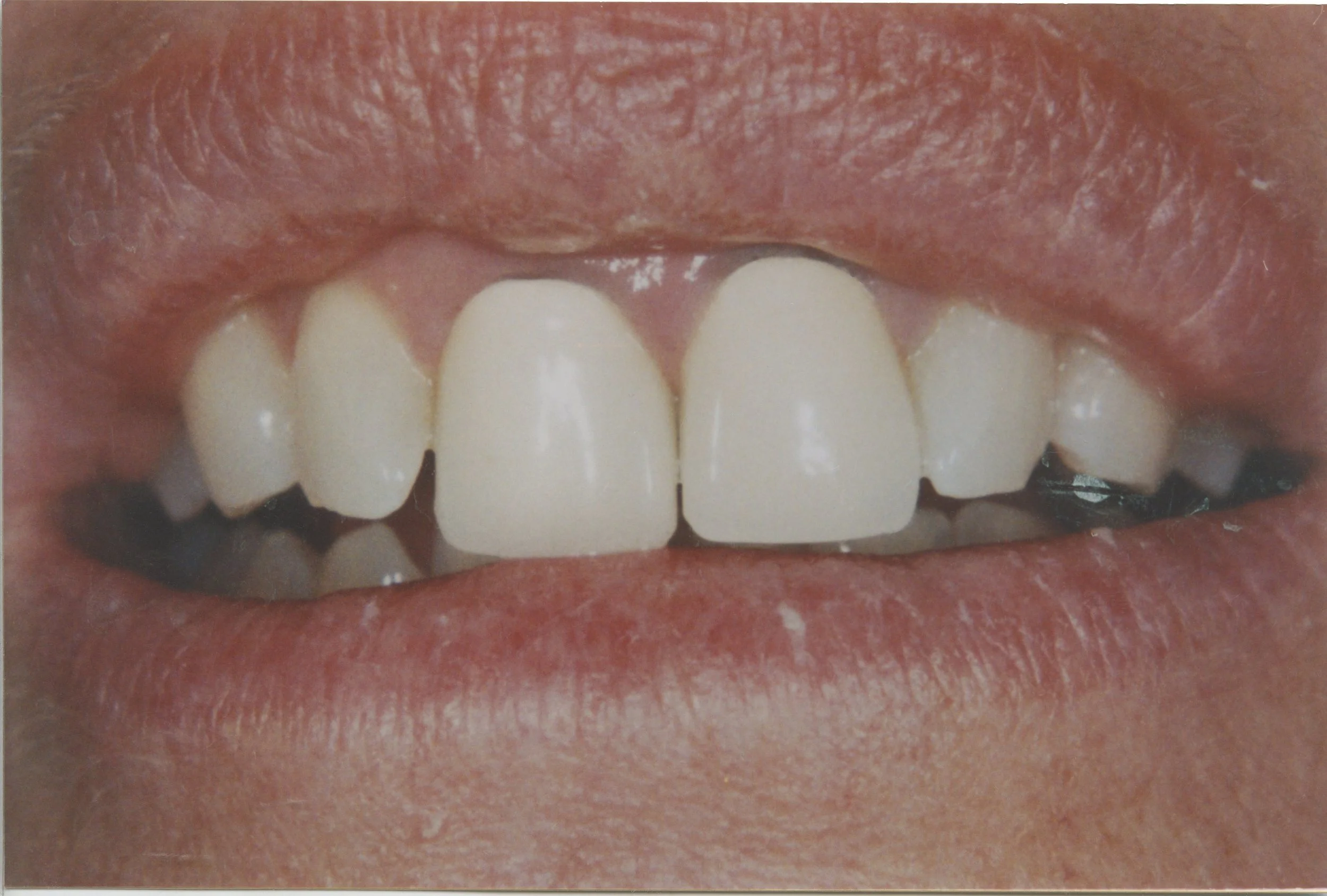 J.P. had some old PFM's (Porcelain Fused to Metal crowns) that we replaced with nice all porcelain crowns
