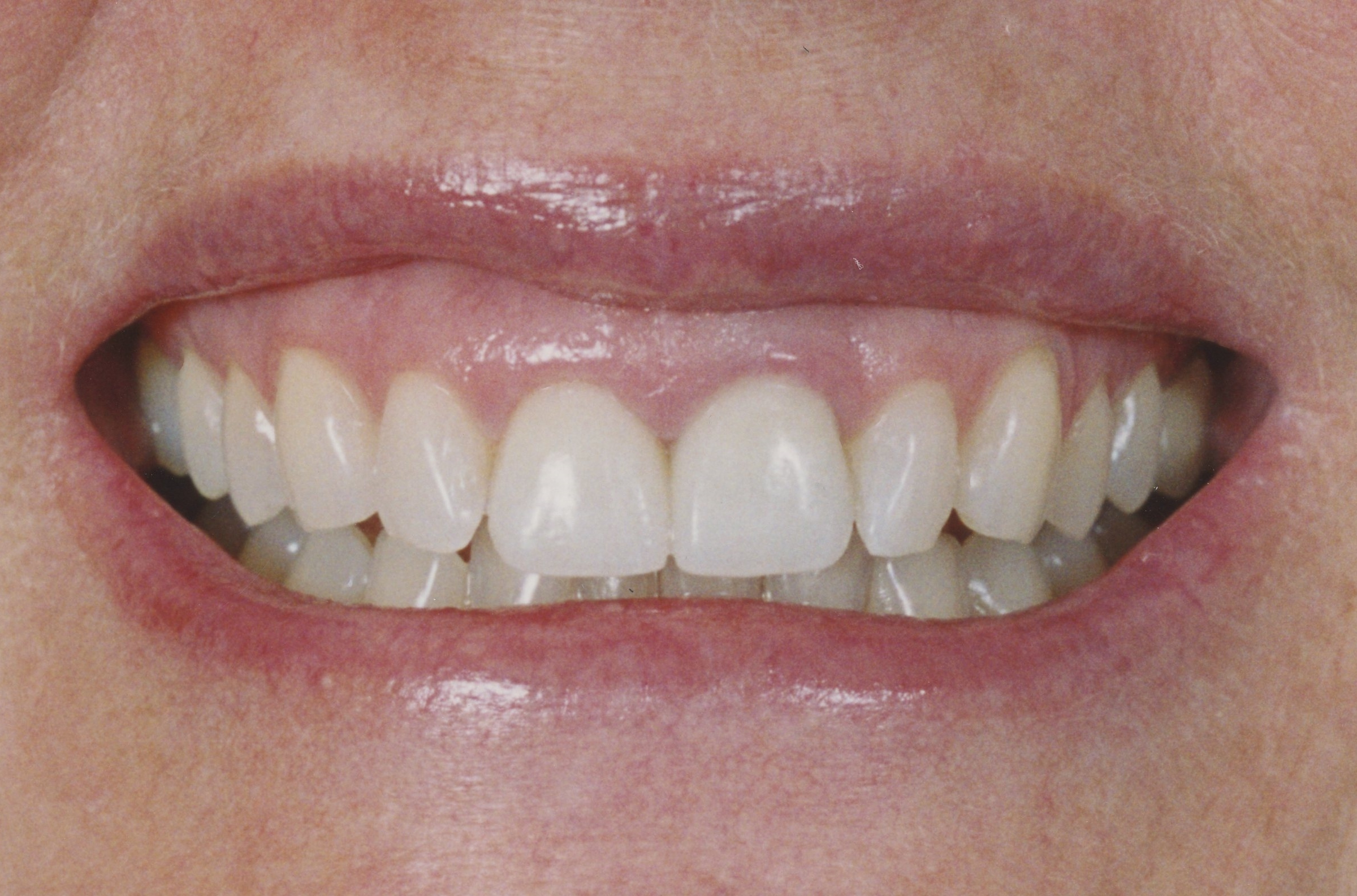 J.P. with some beautiful new, natural looking porcelain crowns