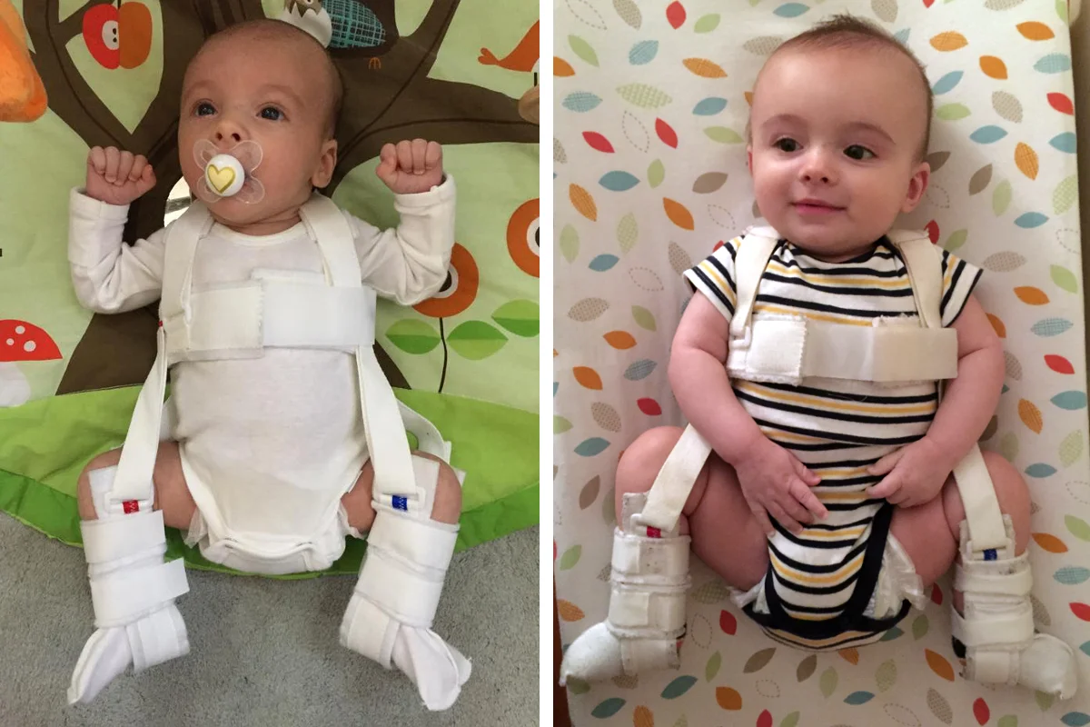 Hip Baby 2.0 - Maddox Edition /// His first day (L) and last day (R) in the Pavlik Harness.