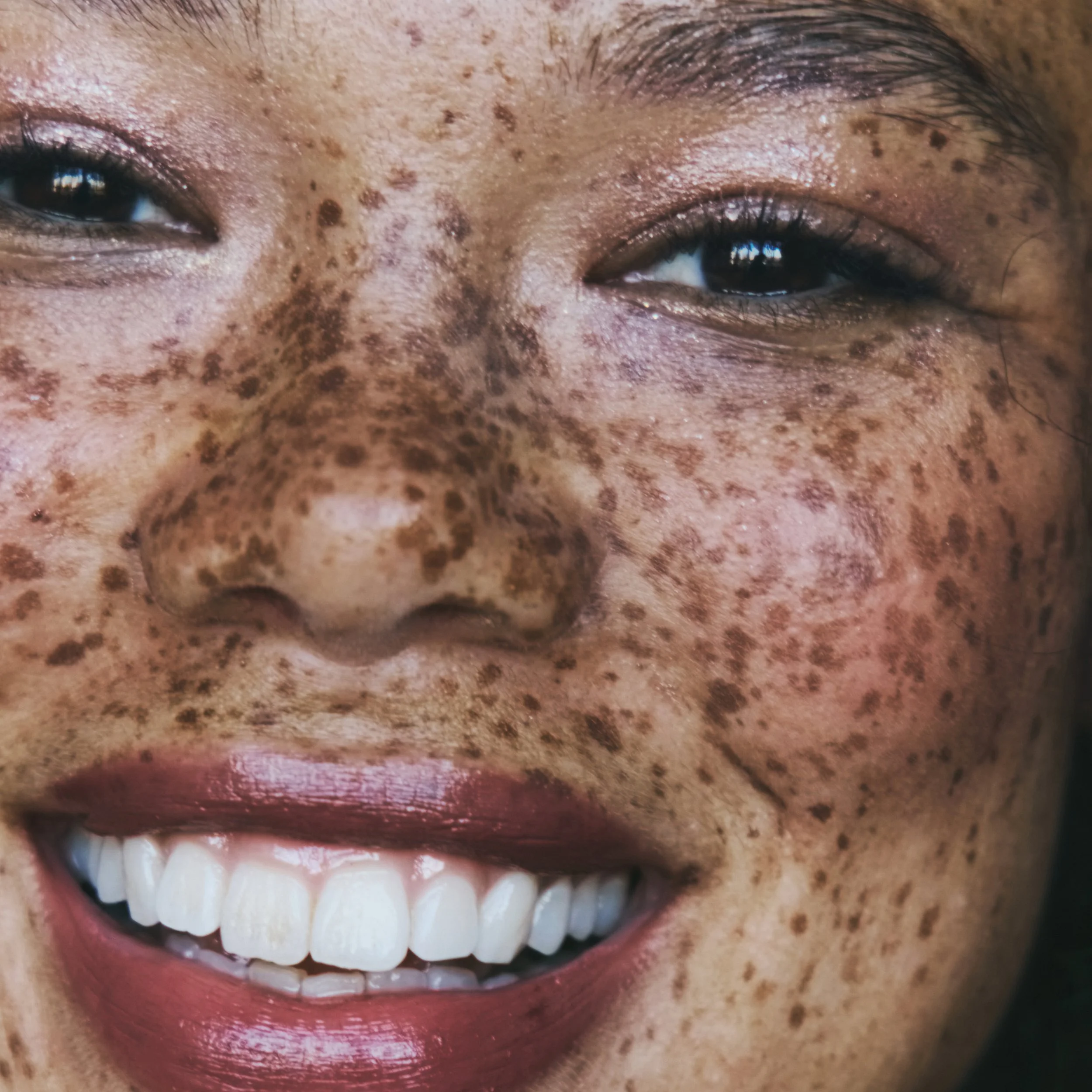 Close-up of a person smiling showing upper teeth, with brown skin and freckles.