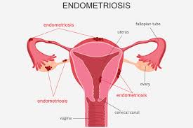 Hey, endometrial tissue, you don’t belong there!