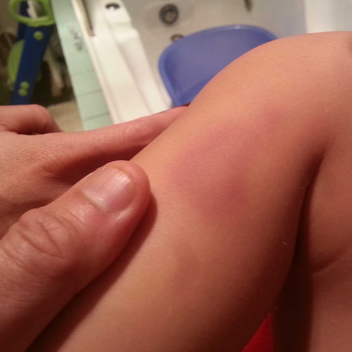 bruise.jpg