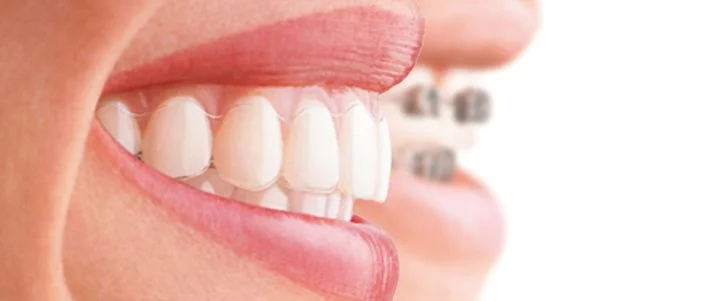INVISALIGN.jpg