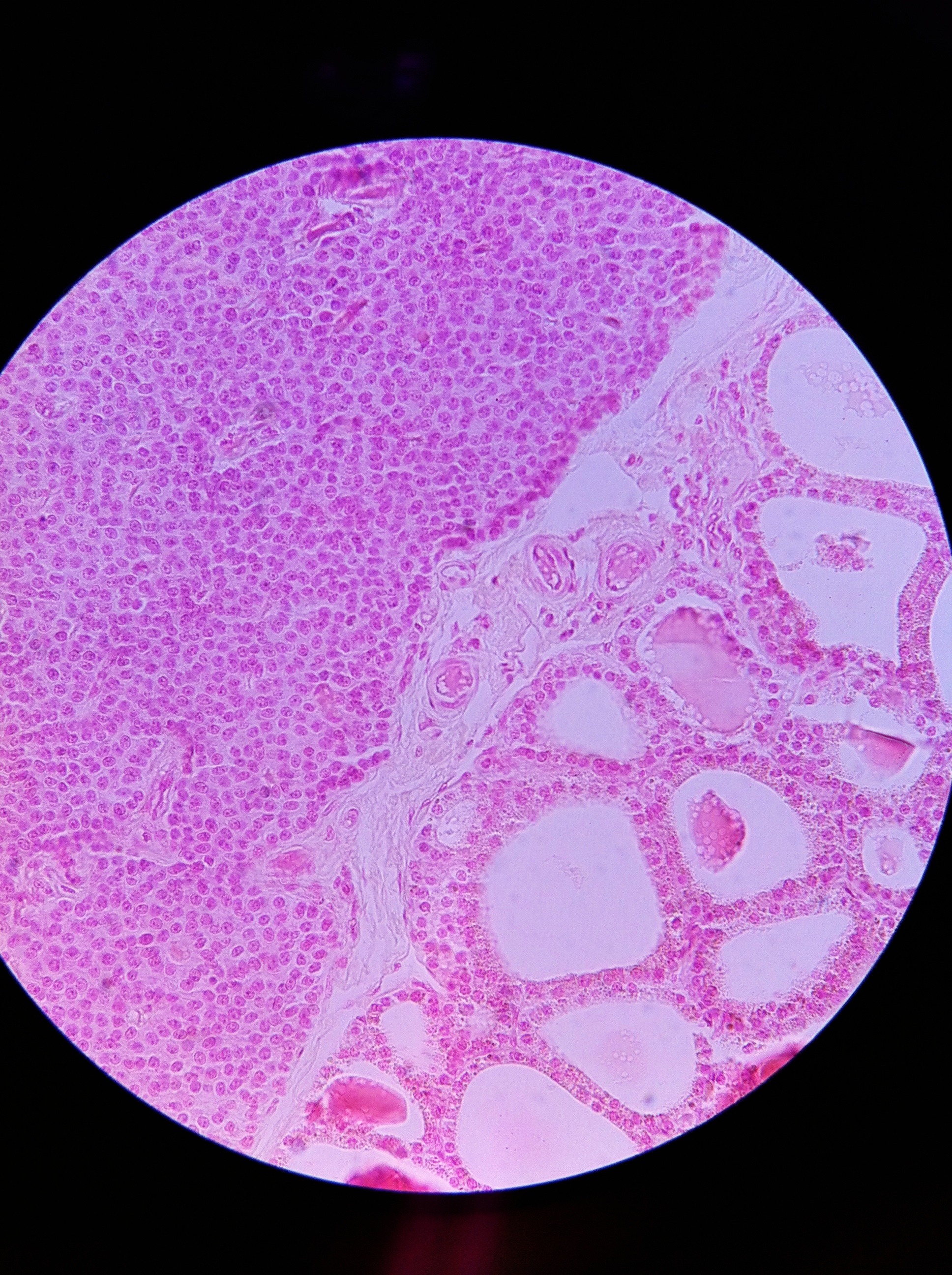 Parathyroid and Thyroid 400X