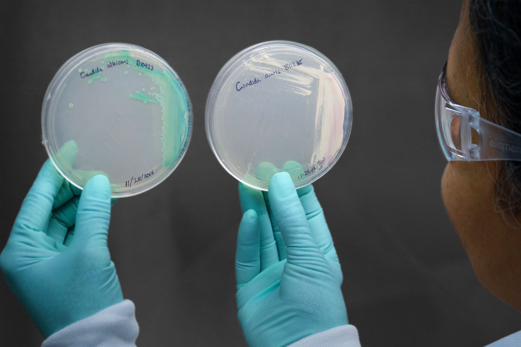 A petri dish of cultured Candida auris, right. When Ms. Spoor’s infection didn’t respond to anti-fungal medications, she was told to get her affairs in order. Credit: Centers for Disease Control and Prevention