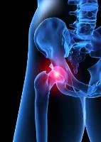 Hip pain.jpg