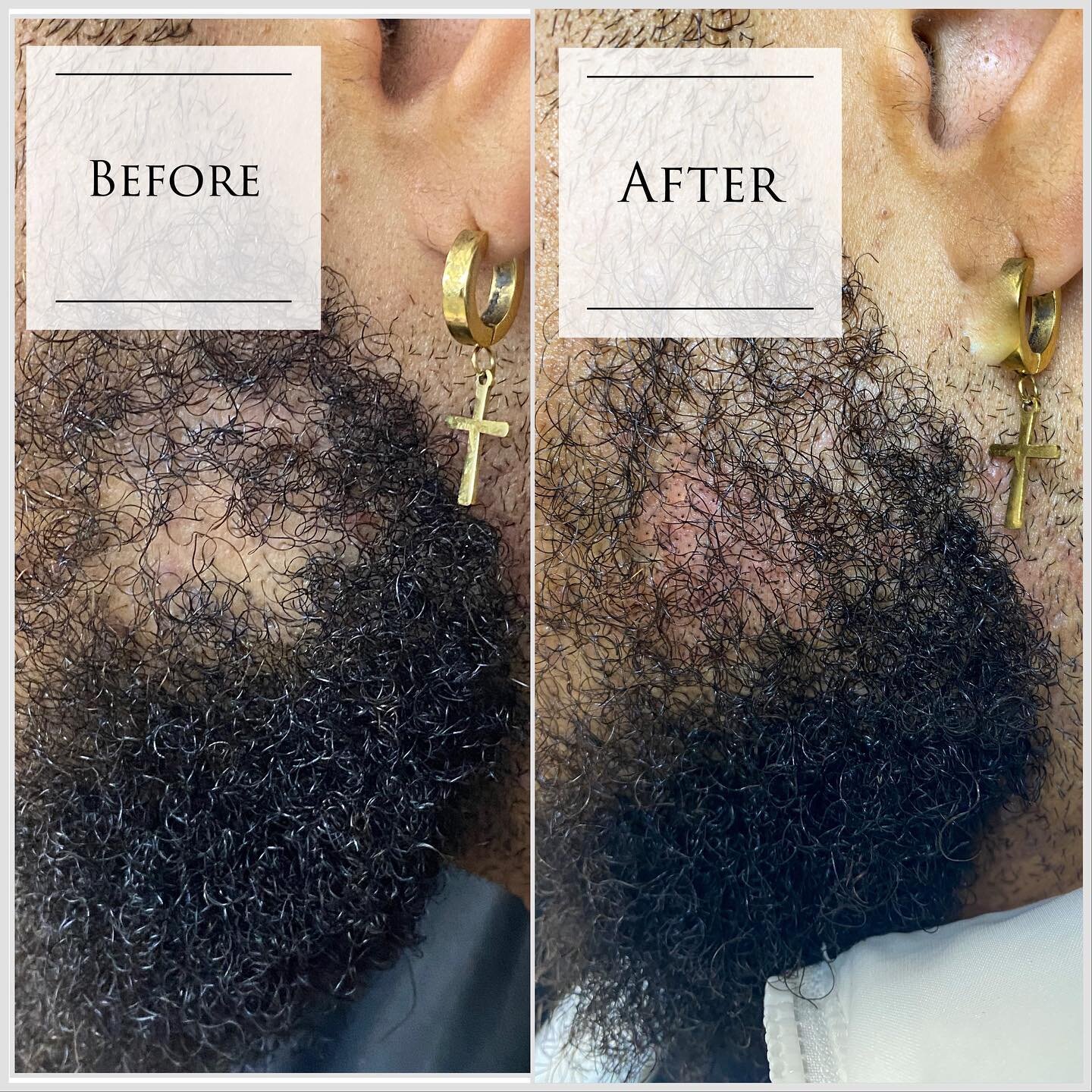 Did you know you can get your beard filled in? 
Typically we have to buzz the beard or hair on the head down, but just like in female density treatments, I can work around the hair if the client doesn&rsquo;t want to shave like in this photo. 
1st ph