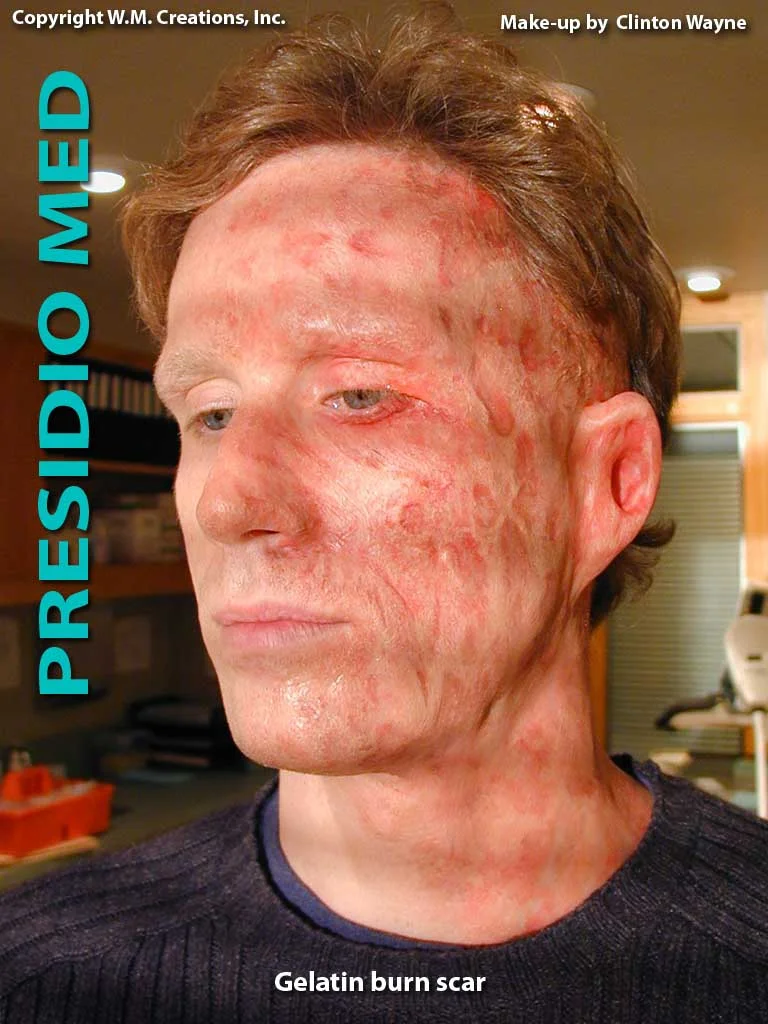 burn scars burn scars