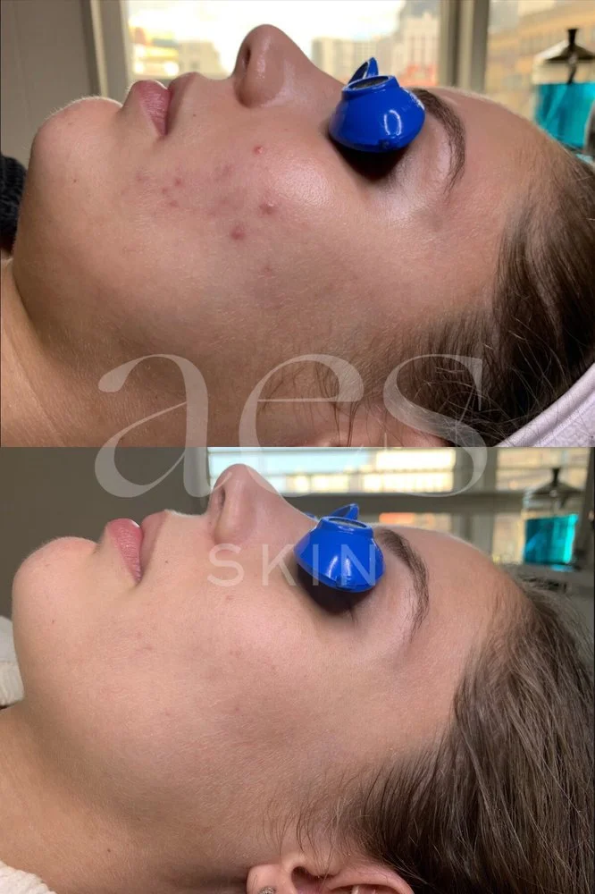 AES Acne Clinic based in the SF Bay Area - holistic skincare products and personalized programs for clear skin.jpg