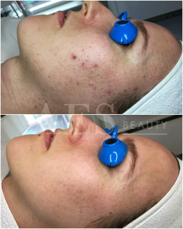 AES Acne Clinic based in the SF Bay Area - holistic skincare products and personalized programs for clear skin.jpg