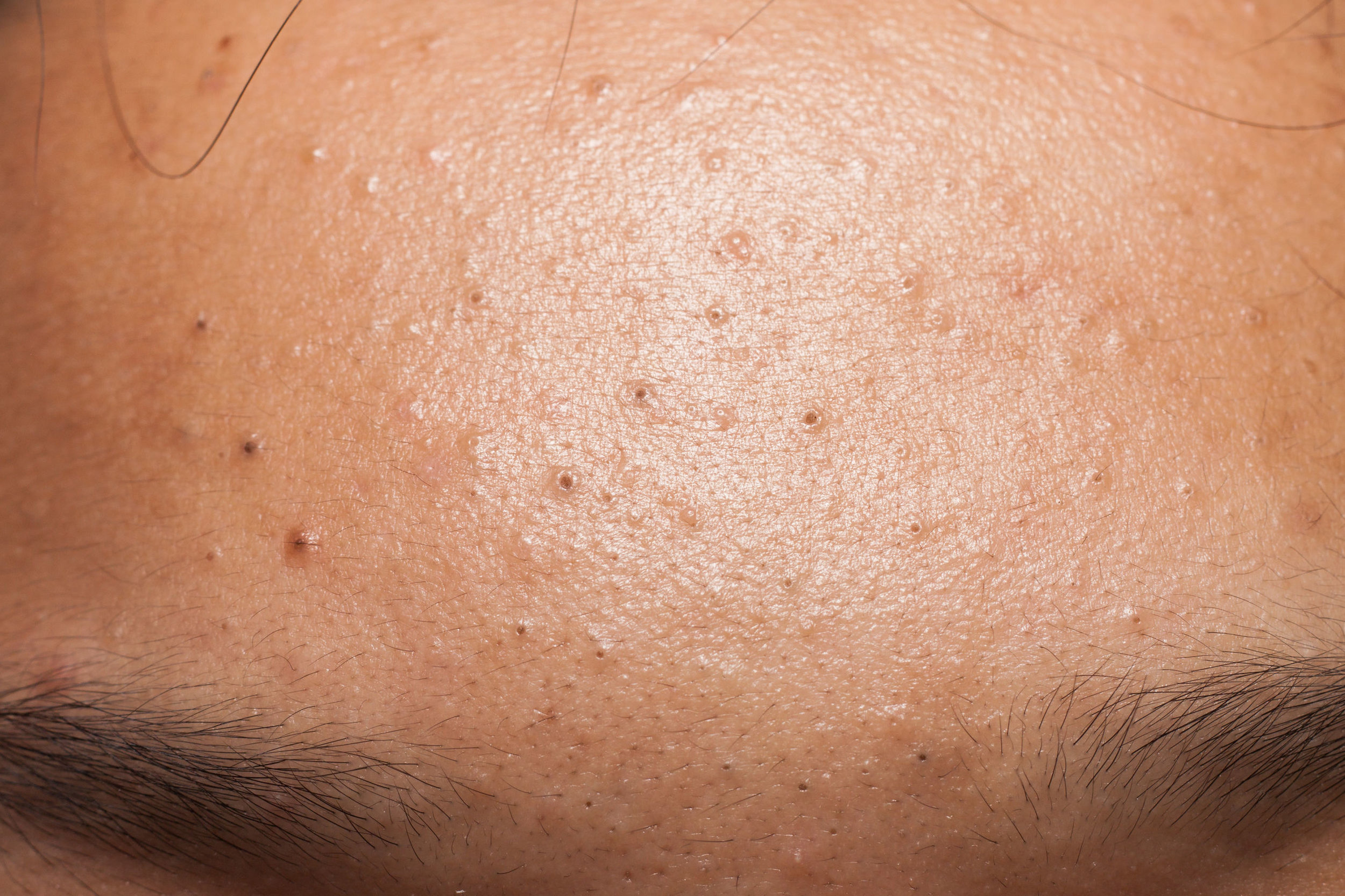 Non-Inflamed Acne