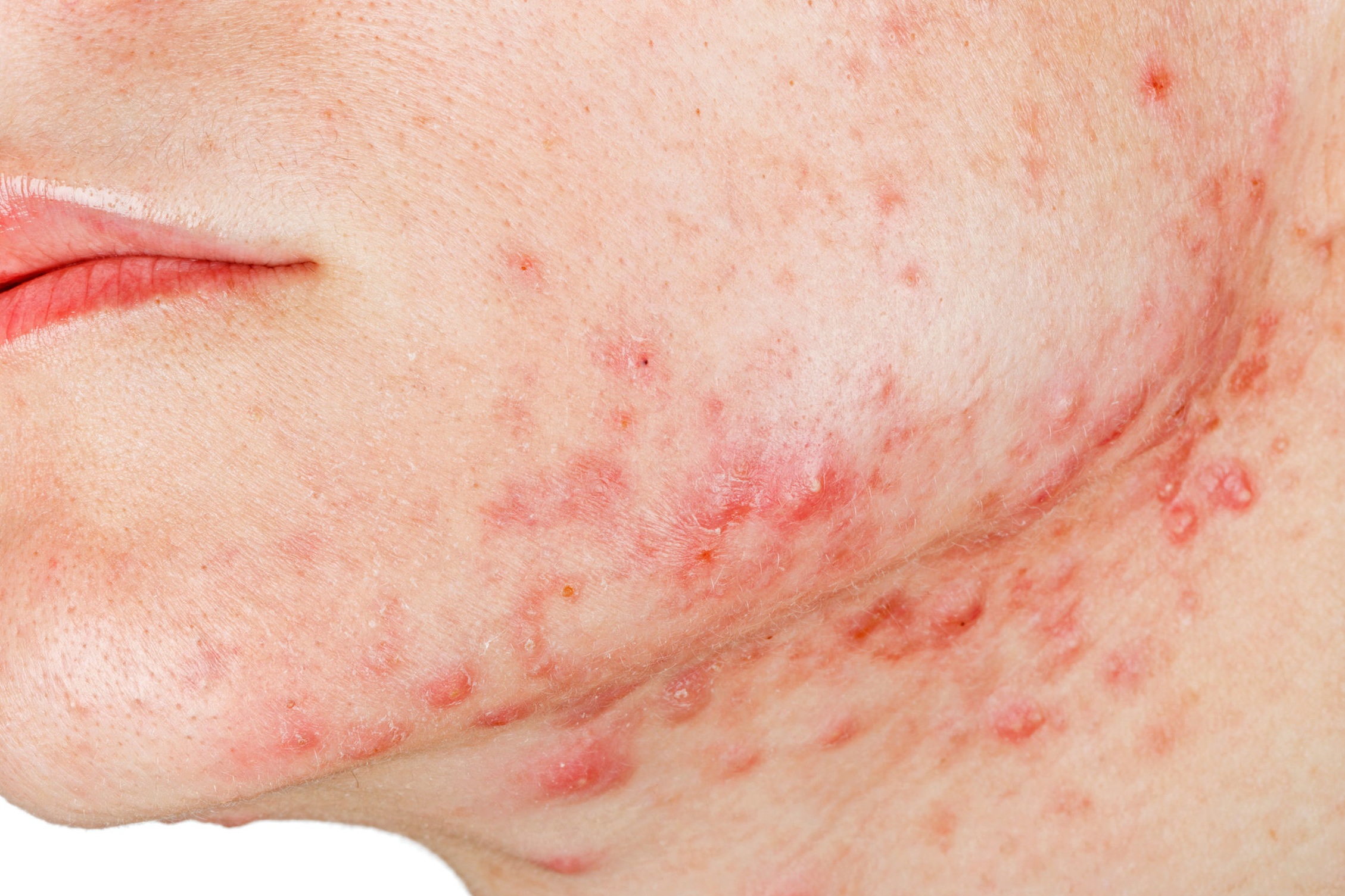 Inflamed Acne