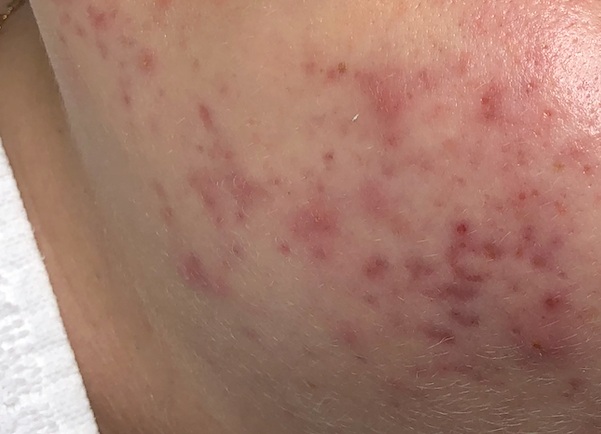 Acne Scars — Coach Kimmy's Blog — AES Acne Clinic San Francisco | Acne Treatments for adult and teenage acne