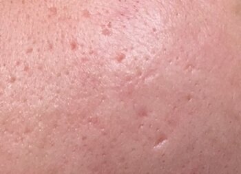 Acne scar