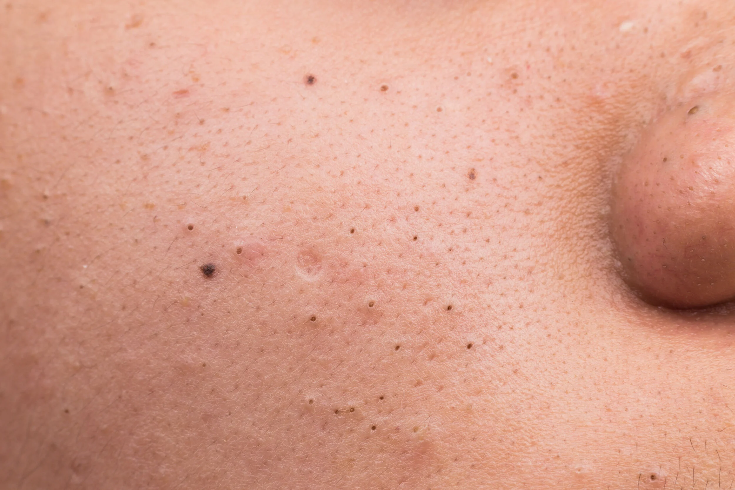 comedogenic acne treatment