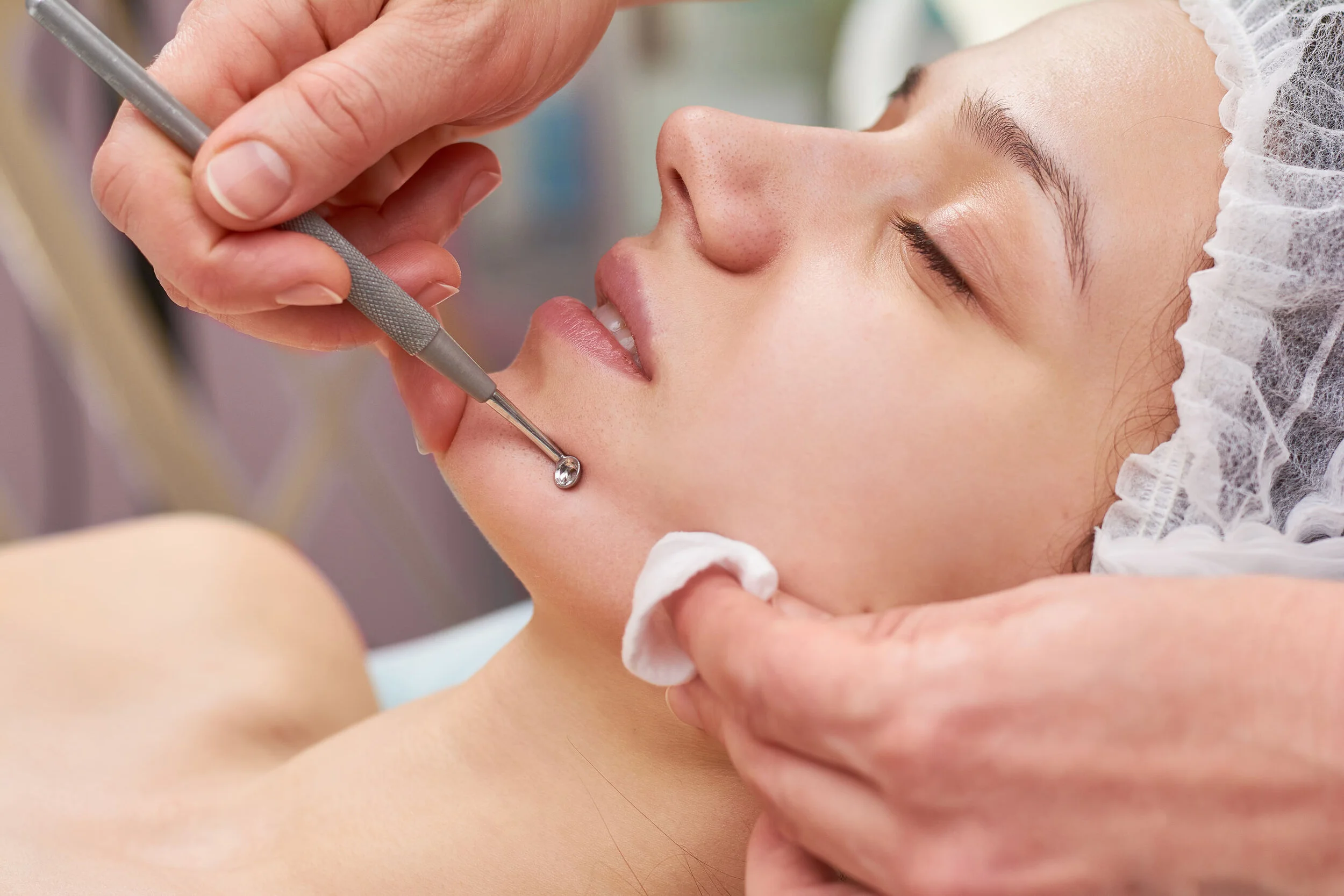 How to tell if your extractions for acne are done properly — AES Acne ...