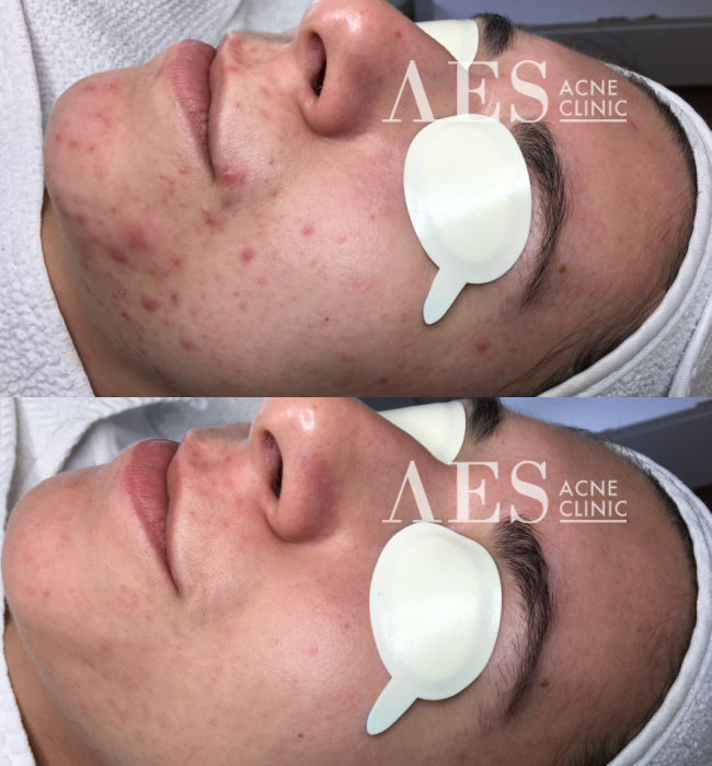 I don't think I realized how much having acne was weighing me down until it was gone.