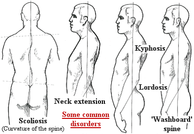 distorsion posture.png