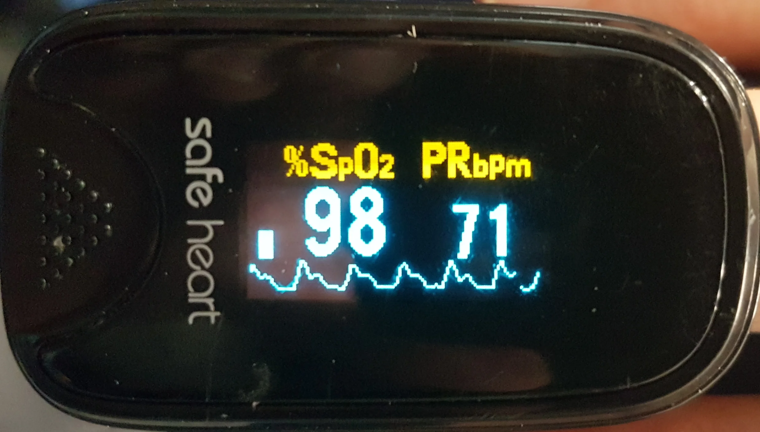 Strong waveform with good dicrotic notch indicating good pulse pressure and perfusion.