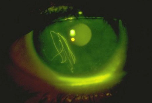 Source: http://reference.medscape.com/features/slideshow/foreign-body-sensation
