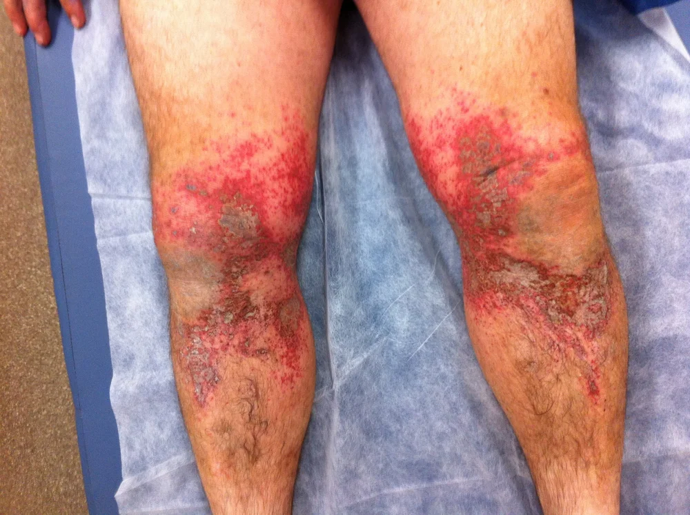 Burns Part 2 Special Cases Real First Aid