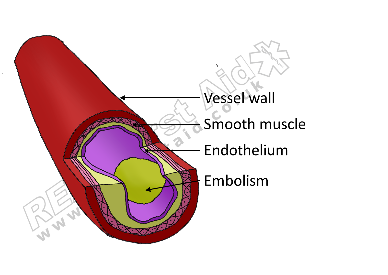 An embolism