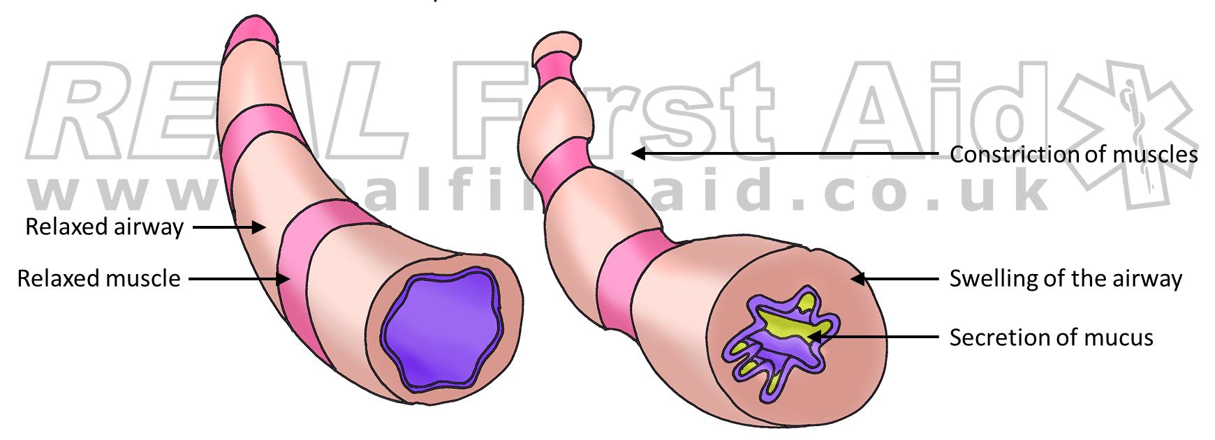 Asthma anotated.png