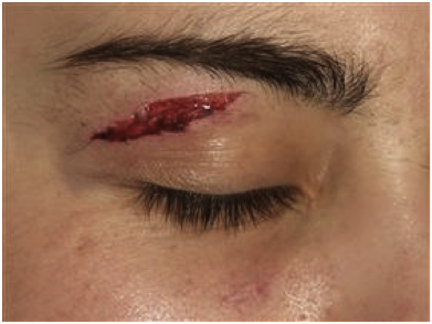Superficial lid laceration