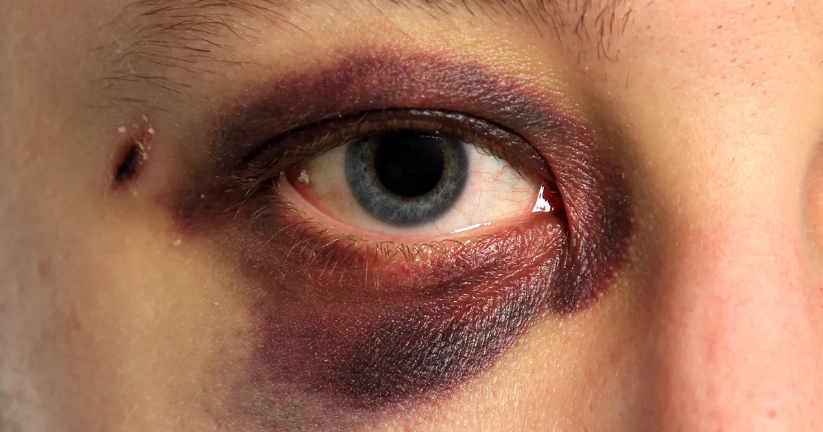 Periorbital haemotoma…..black eye.