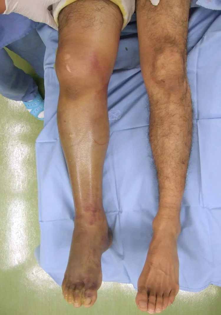 Crush Injury — REAL First Aid