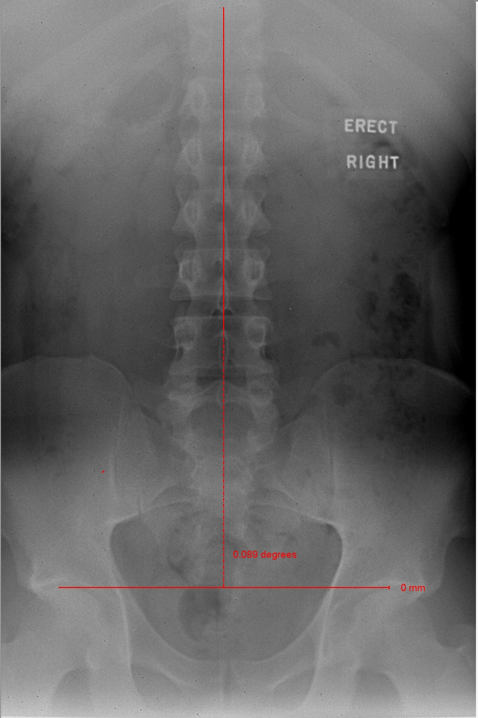 A_Normal A-P Lumbar Spine.jpg