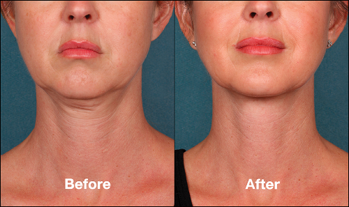 KybellaPatientPR3BeforeAfter(FrontView).png