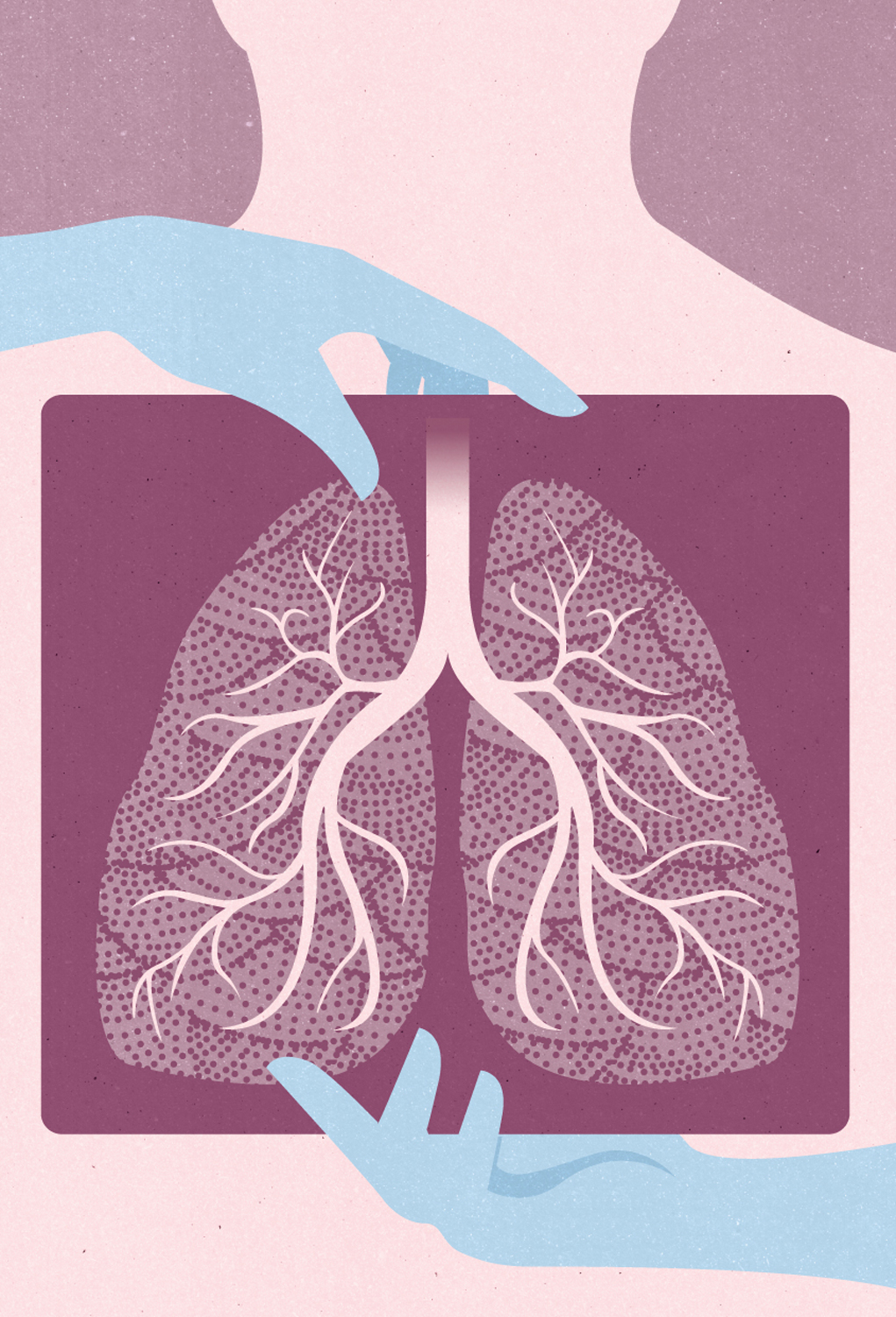 Pulmonary Fibrosis