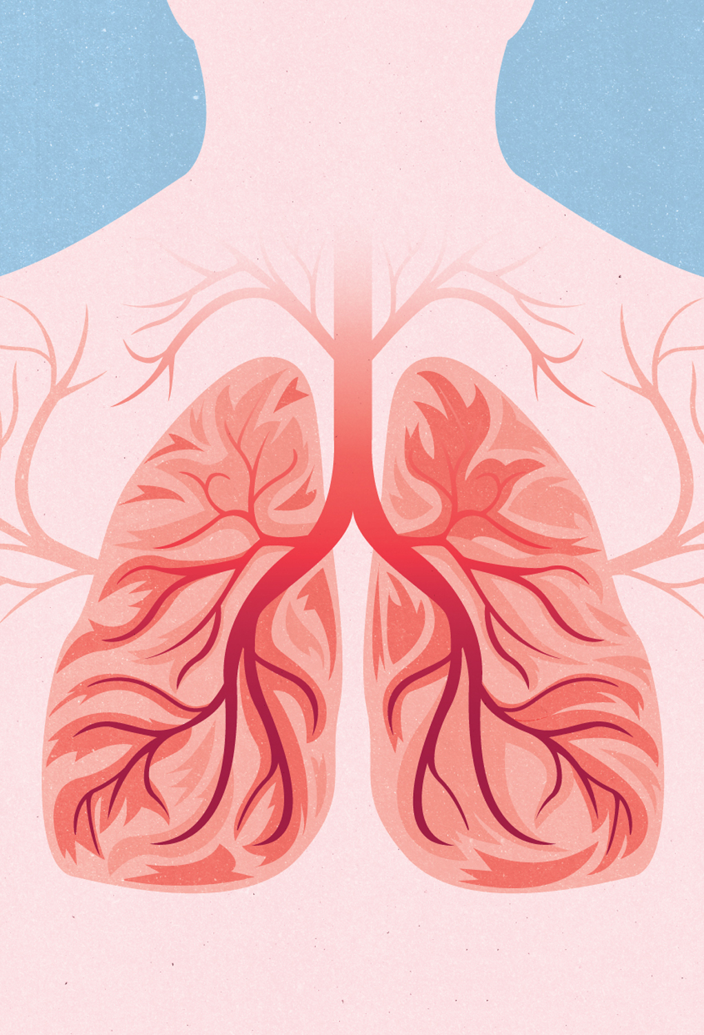 Sarcoidosis