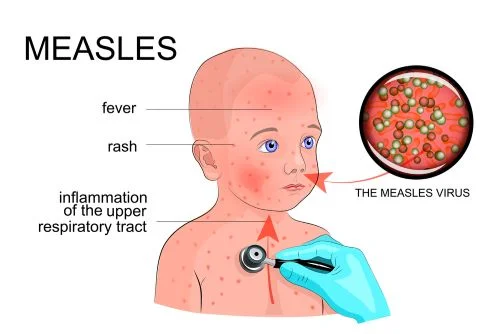 Measles.jpg