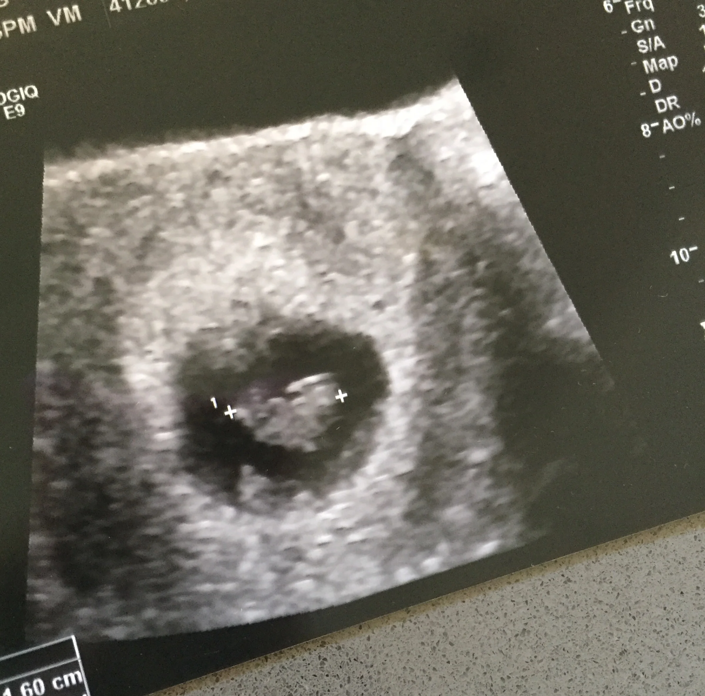A picture of our little peanut seven weeks ago. There's just 1! And it looks like it's supposed to! And has a heartbeat! 