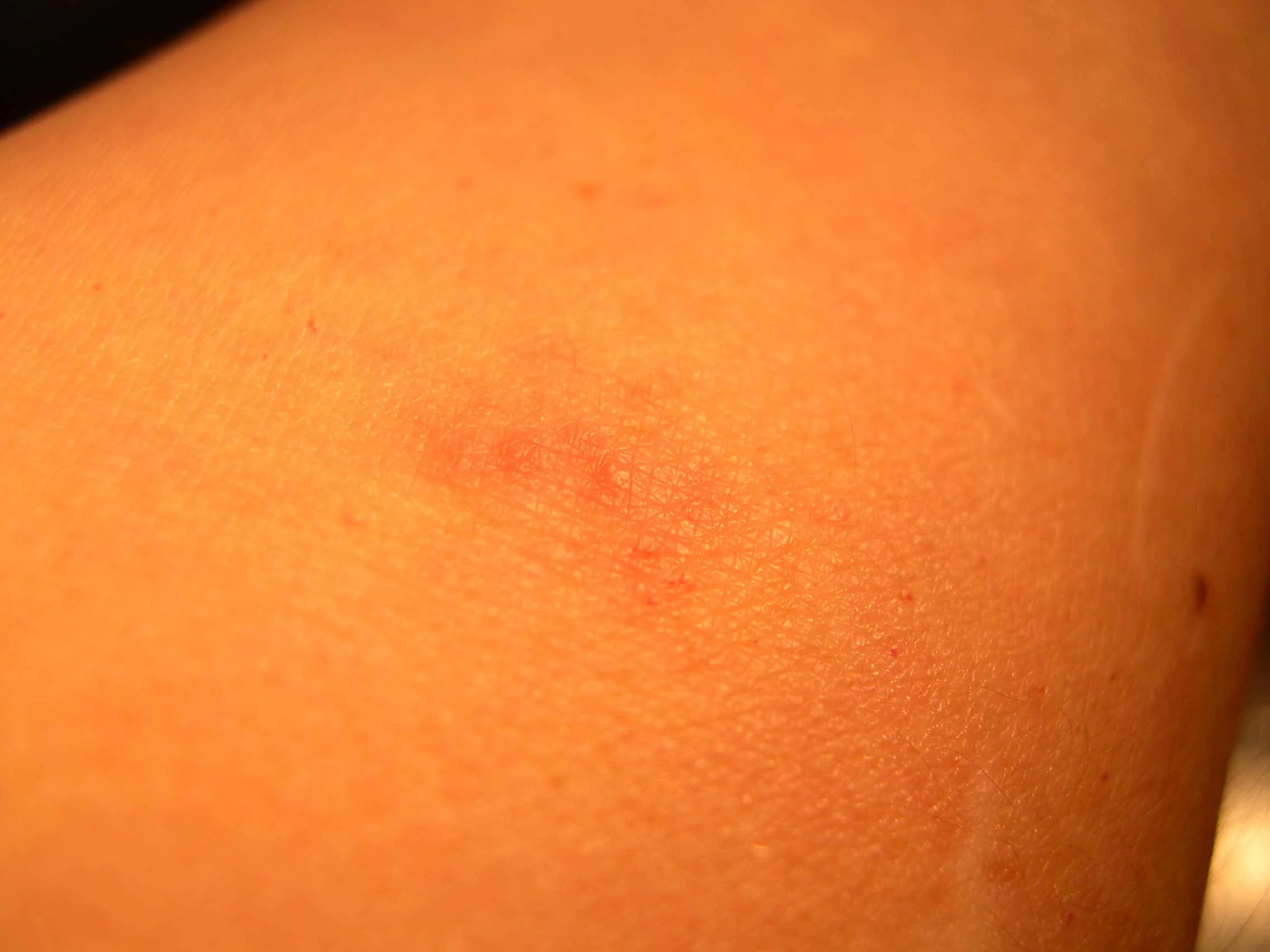 Bed Bug Bite Marks