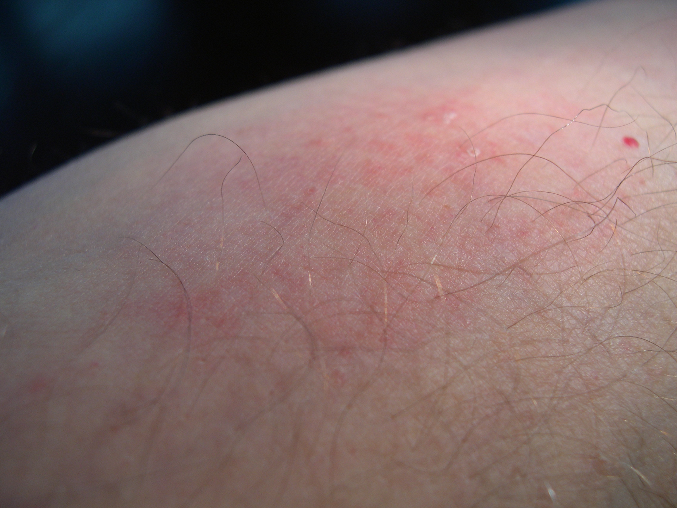 Bed Bug Bite Marks (3/3)