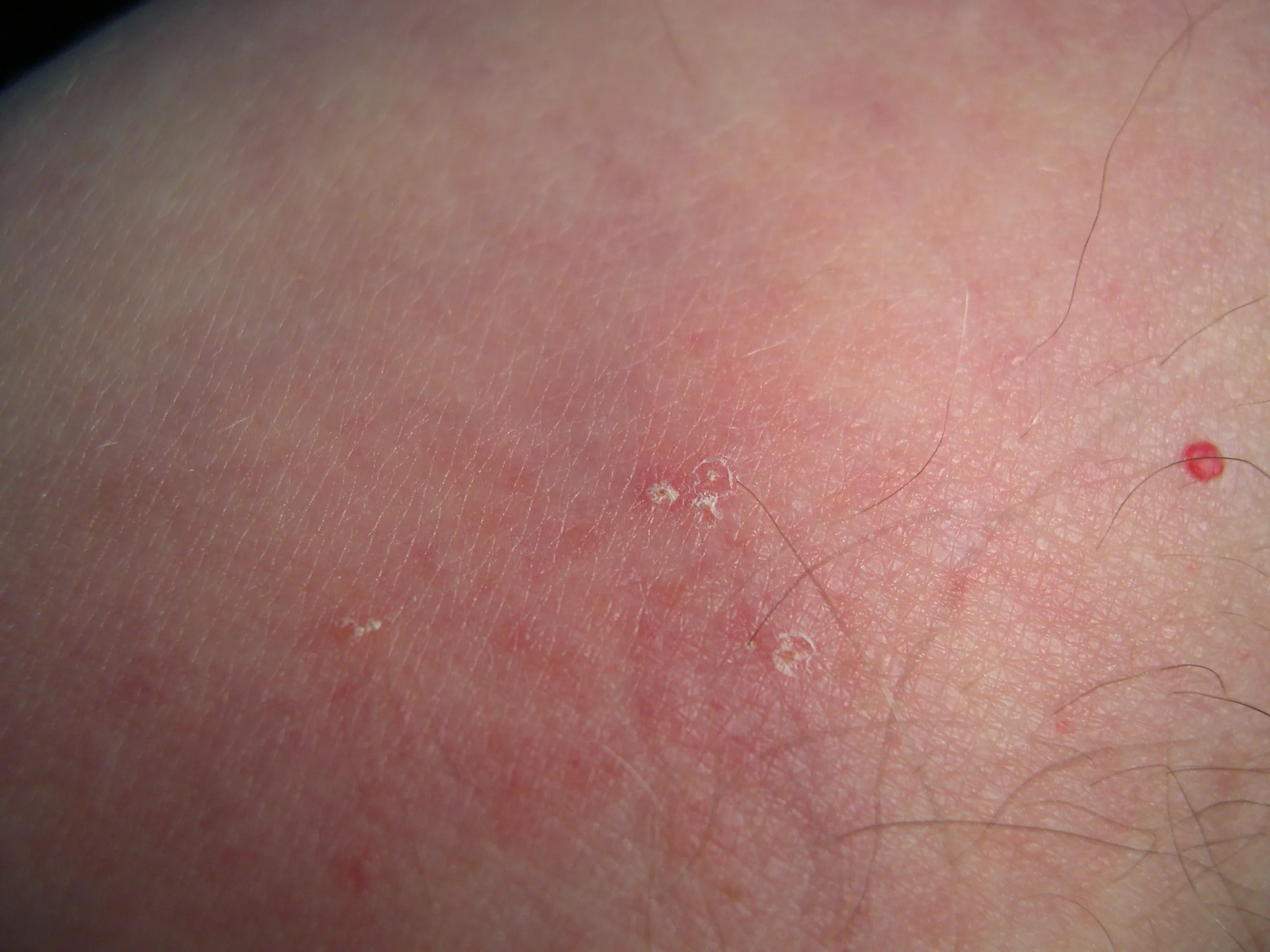 Bed Bug Bite Marks (2/3)